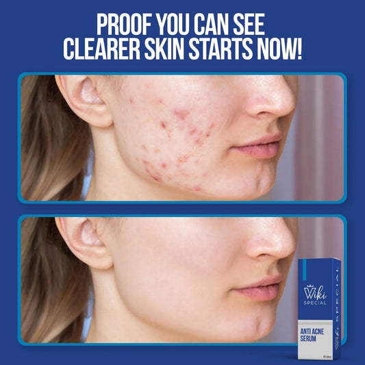 *Wiki Special Anti-Acne Serum – 30ml | Deep Pore Cleansing &amp; Blemish Control Formula**